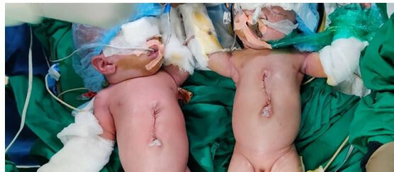 Doctors at BJ Wadia Hospital successfully separate new-born conjoined twins