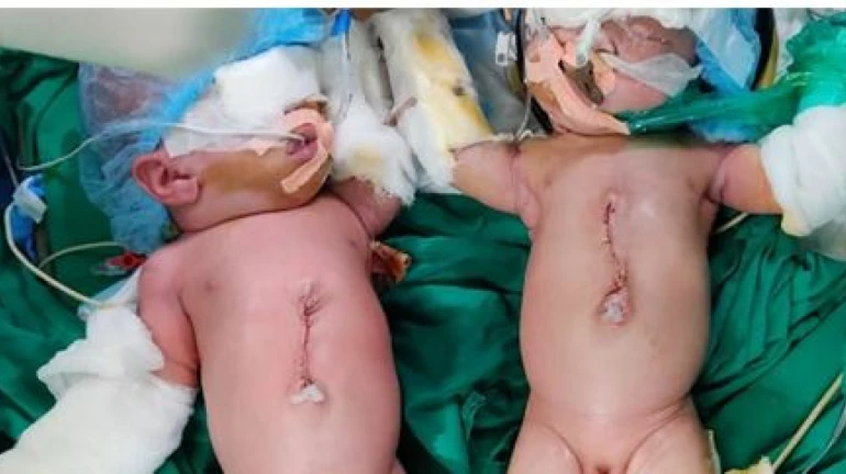 छातीपासून बेंबीपर्यंत जोडलेल्या १४ दिवसांच्या जुळ्या मुलींवर यशस्वी शस्त्रक्रिया