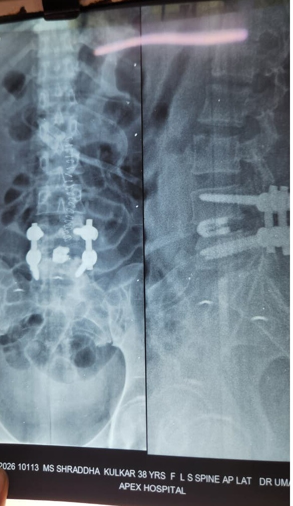 Unable to Walk Properly for 2 Years, 37-Year-Old Mumbai Woman Walks Pain-Free Within a Day After Advanced Spine Surgery