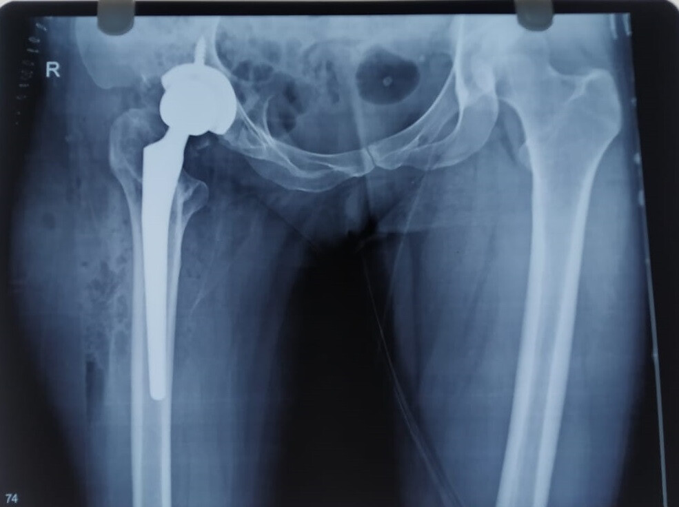 47-year-old Thane woman suffering from congenital dysplastic hip with arthritis gets back her normal life