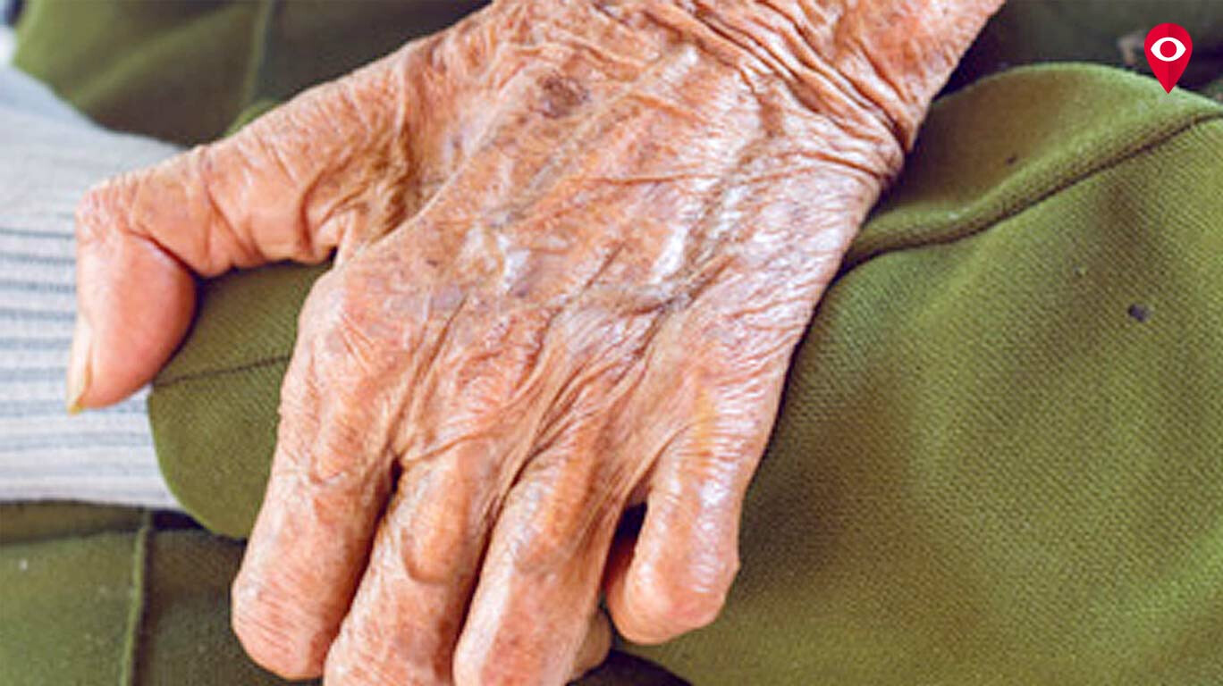 Leprosy cases on the rise in Mumbai Mumbai Mumbai Live