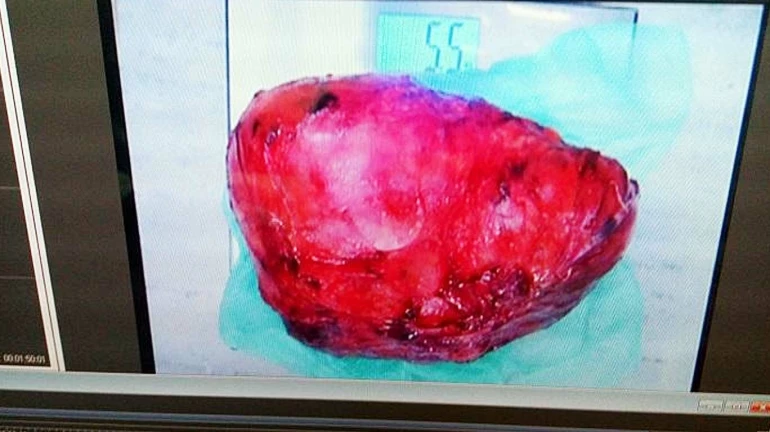 सायन हॉस्पिटल का कारनामा, मरीज के शरीर से निकाला दुनिया का सबसे बड़ा ट्यूमर