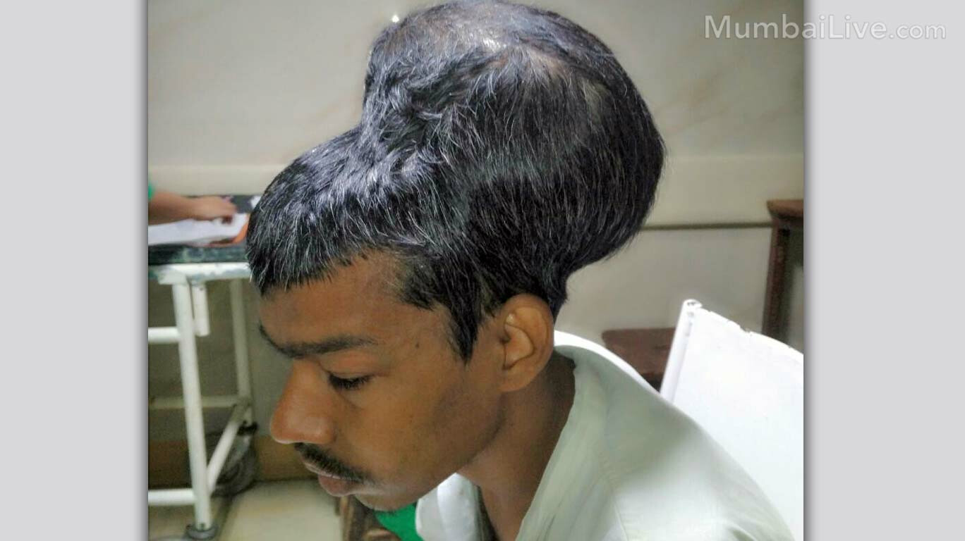 Doctors in Mumbai Removed World's Largest Brain Tumor Doctors in Mumbai Removed World's Largest Brain Tumor