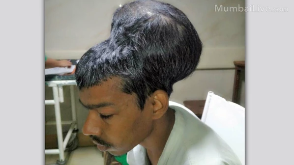 नायरमध्ये डॉक्टरांनी काढला जगातला सर्वात मोठा ब्रेन ट्युमर!