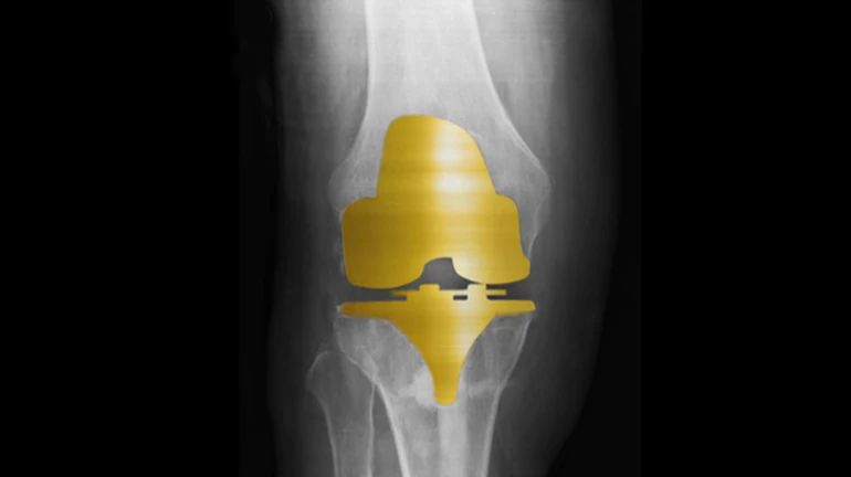 First-of-its-kind ‘Golden Knee Replacement’ takes place in Navi Mumbai’s Wockhardt Hospital