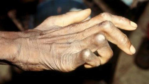 कृष्ठरोगी रुग्णांसाठी रेटिनाच्या माध्यमातून आधार क्रमांक काढणार