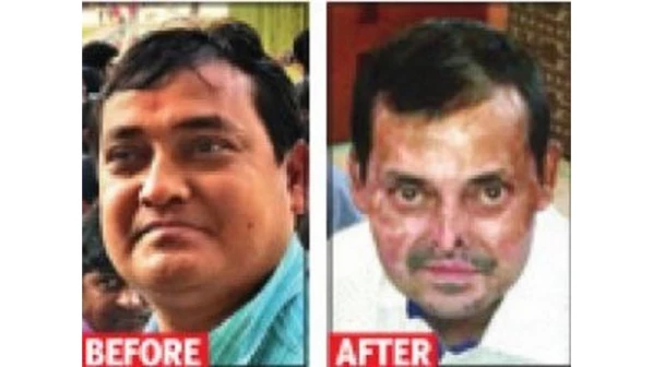 Laptop explodes on a man's face; undergoes 25 surgeries