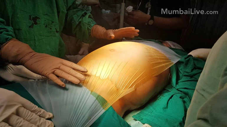 १४ वर्षाच्या मुलीच्या पोटात १७ किलोचा ट्यूमर, कामा रुग्णालयातील डाॅक्टरांची यशस्वी शस्त्रक्रिया