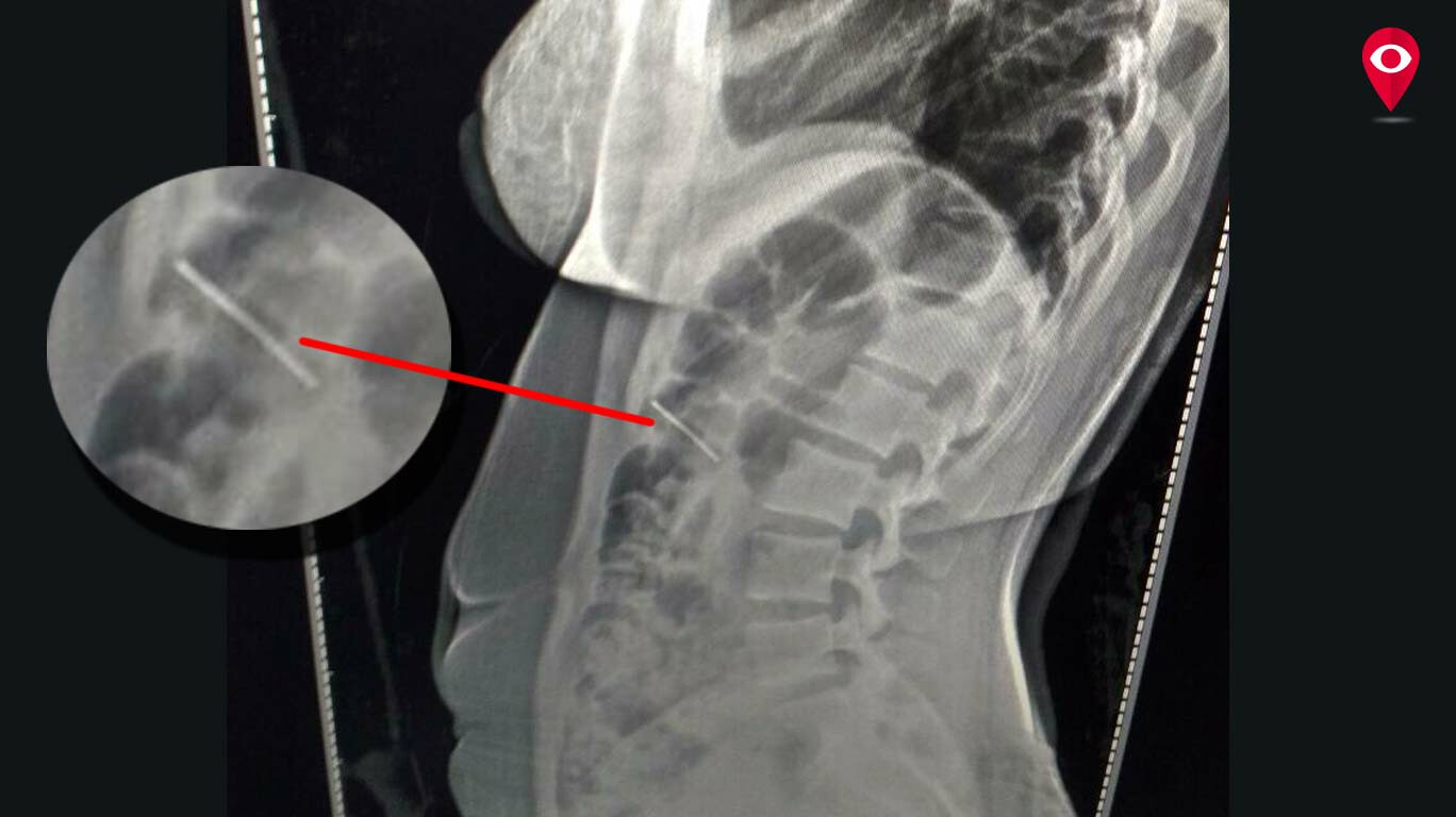 Woman swallows needle while sewing