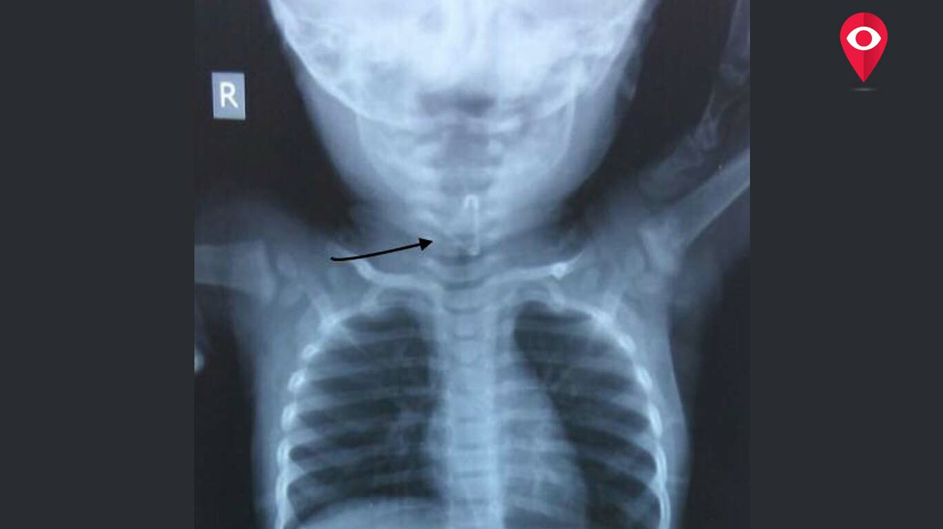 11monthold baby swallows a safety pin, Wockhardt doc saves a life